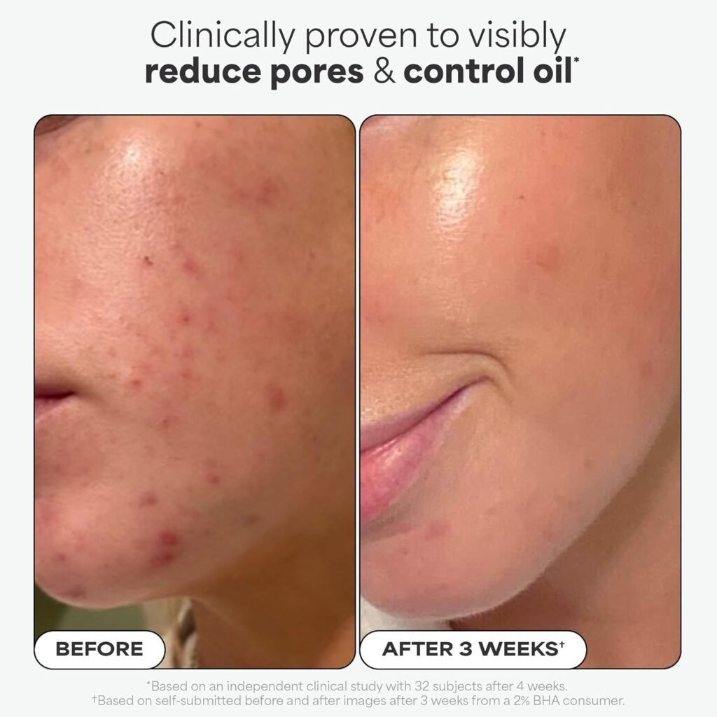 BHA Liquid Exfoliant